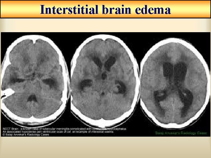 Interstitial brain edema Interstitial brain edema