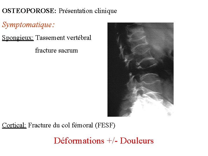 OSTEOPOROSE: Présentation clinique Symptomatique: Spongieux: Tassement vertébral fracture sacrum Cortical: Fracture du col fémoral