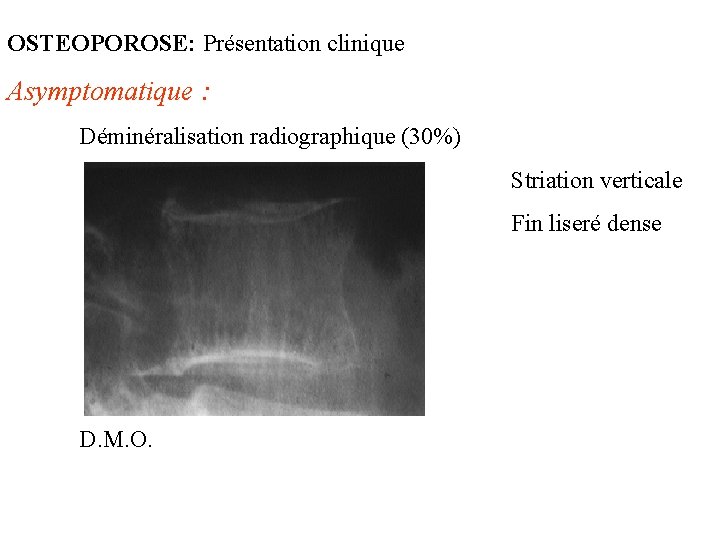 OSTEOPOROSE: Présentation clinique Asymptomatique : Déminéralisation radiographique (30%) Striation verticale Fin liseré dense D.