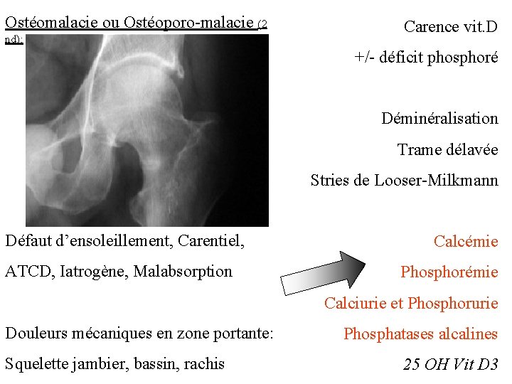 Ostéomalacie ou Ostéoporo-malacie (2 nd): Carence vit. D +/- déficit phosphoré Déminéralisation Trame délavée