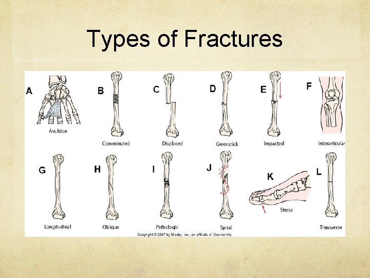 Types of Fractures 