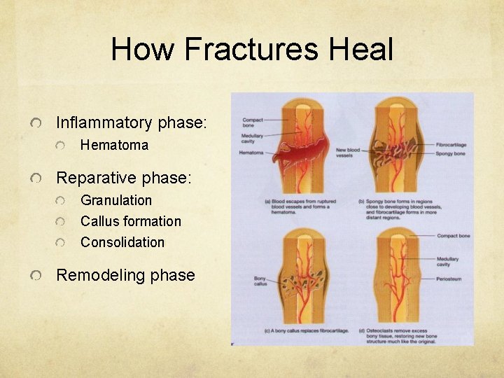 How Fractures Heal Inflammatory phase: Hematoma Reparative phase: Granulation Callus formation Consolidation Remodeling phase