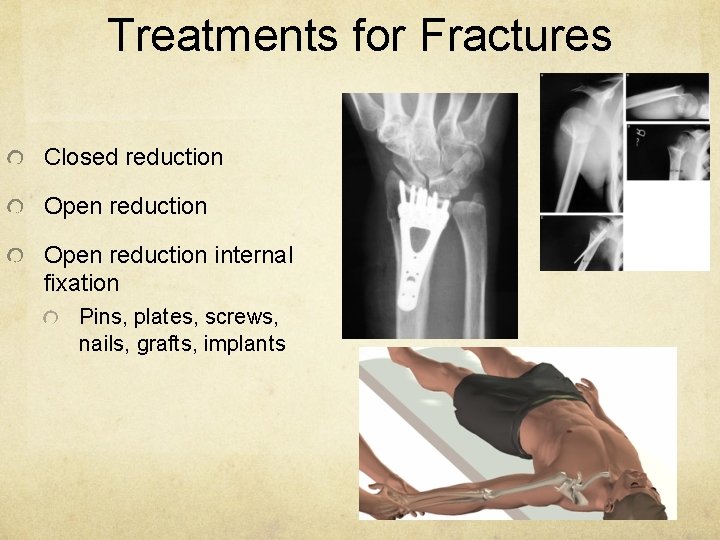 Treatments for Fractures Closed reduction Open reduction internal fixation Pins, plates, screws, nails, grafts,