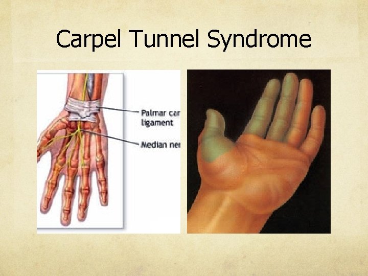 Carpel Tunnel Syndrome 