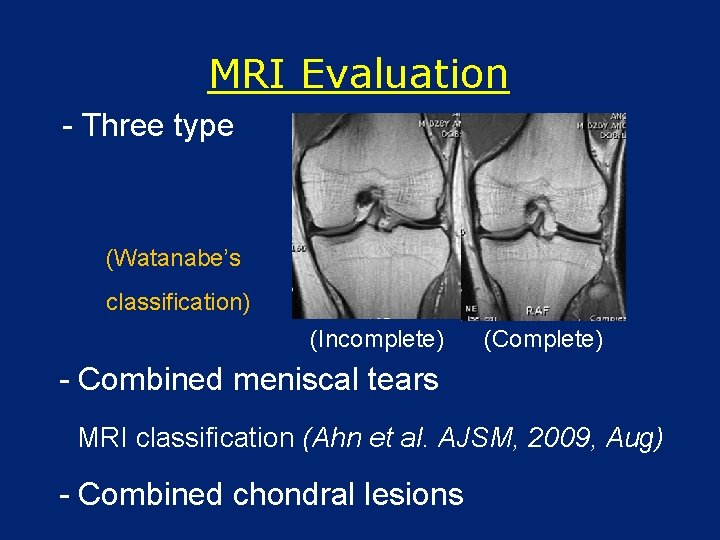 MRI Evaluation - Three type (Watanabe’s classification) (Incomplete) (Complete) - Combined meniscal tears MRI