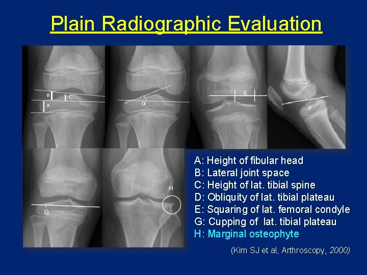 Plain Radiographic Evaluation A: Height of fibular head B: Lateral joint space C: Height