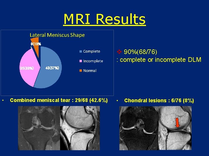 MRI Results 8(10% ) 25(33%) • v 90%(68/76) : complete or incomplete DLM 43(57%)