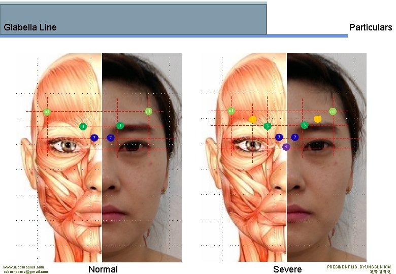 Glabella Line www. reborncorea. com reborncorea@gmail. com Particulars Normal Severe PRESIDENT MD. BYUNGSUN KIM
