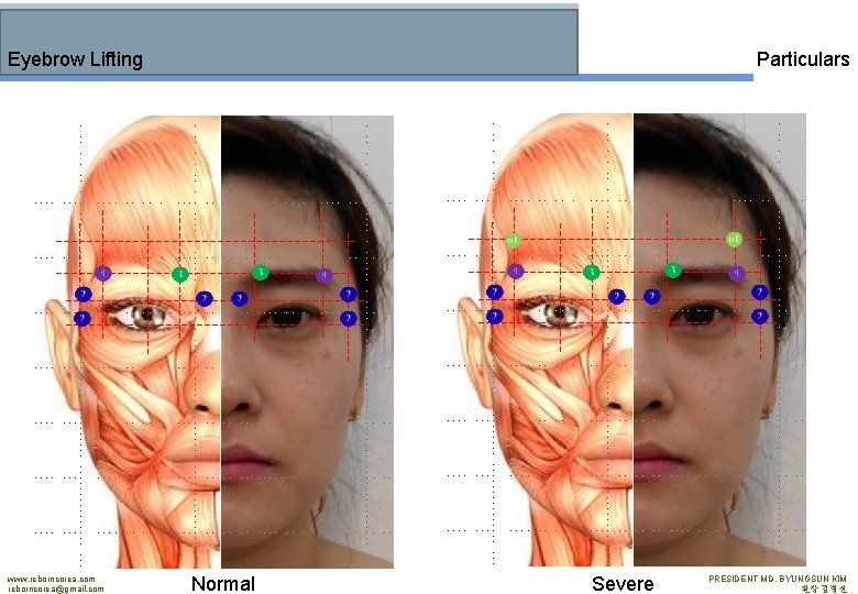 Particulars Eyebrow Lifting www. reborncorea. com reborncorea@gmail. com Normal Severe PRESIDENT MD. BYUNGSUN KIM