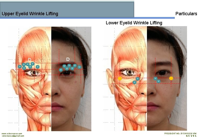 Upper Eyelid Wrinkle Lifting Particulars Lower Eyelid Wrinkle Lifting D www. reborncorea. com reborncorea@gmail.
