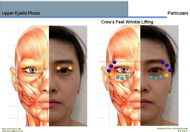 Upper Eyelid Ptosis Particulars Crow’s Feet Wrinkle Lifting www. reborncorea. com reborncorea@gmail. com PRESIDENT