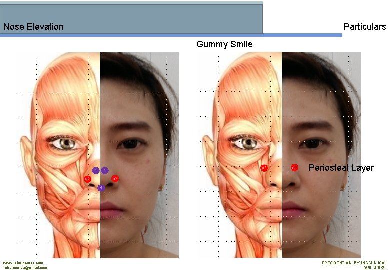 Particulars Nose Elevation Gummy Smile Periosteal Layer www. reborncorea. com reborncorea@gmail. com PRESIDENT MD.