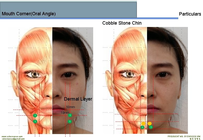 Mouth Corner(Oral Angle) Particulars Cobble Stone Chin Dermal Layer 10 mm www. reborncorea. com