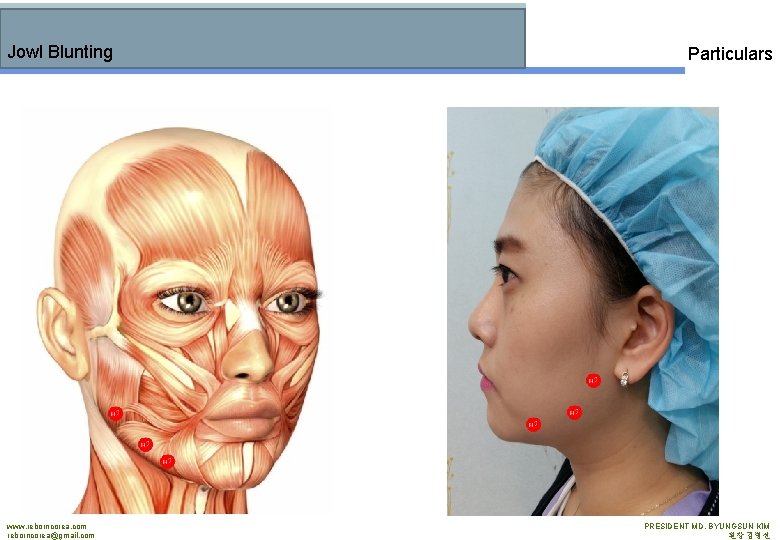 Jowl Blunting www. reborncorea. com reborncorea@gmail. com Particulars PRESIDENT MD. BYUNGSUN KIM 원장 김병선