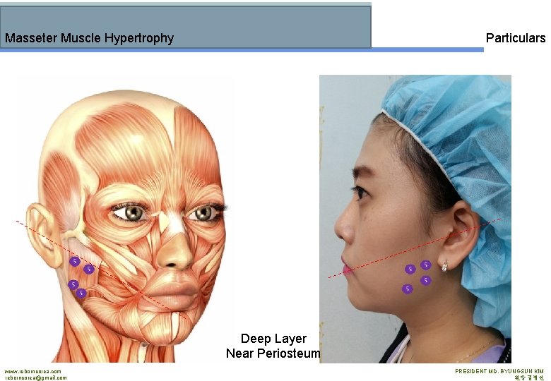 Masseter Muscle Hypertrophy Particulars Deep Layer Near Periosteum www. reborncorea. com reborncorea@gmail. com PRESIDENT