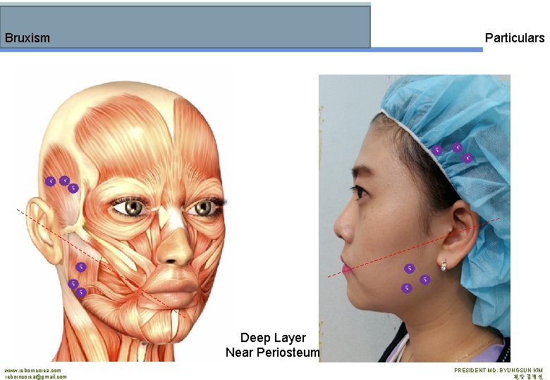 Bruxism Particulars Deep Layer Near Periosteum www. reborncorea. com reborncorea@gmail. com PRESIDENT MD. BYUNGSUN