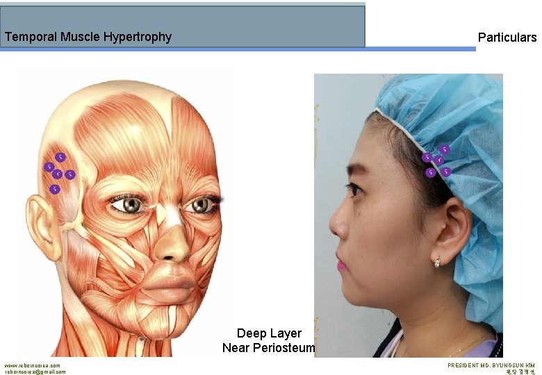 Temporal Muscle Hypertrophy Particulars Deep Layer Near Periosteum www. reborncorea. com reborncorea@gmail. com PRESIDENT