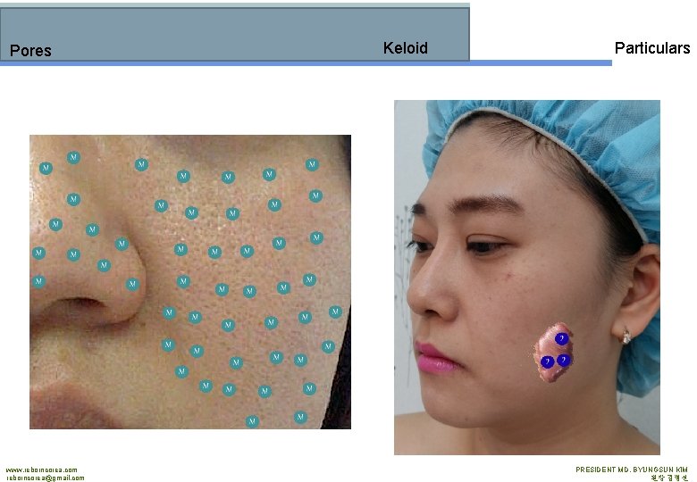 Pores www. reborncorea. com reborncorea@gmail. com Keloid Particulars PRESIDENT MD. BYUNGSUN KIM 원장 김병선