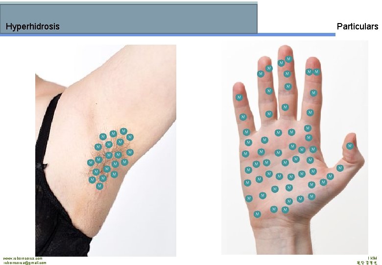 Hyperhidrosis www. reborncorea. com reborncorea@gmail. com Particulars PRESIDENT MD. BYUNGSUN KIM 원장 김병선 