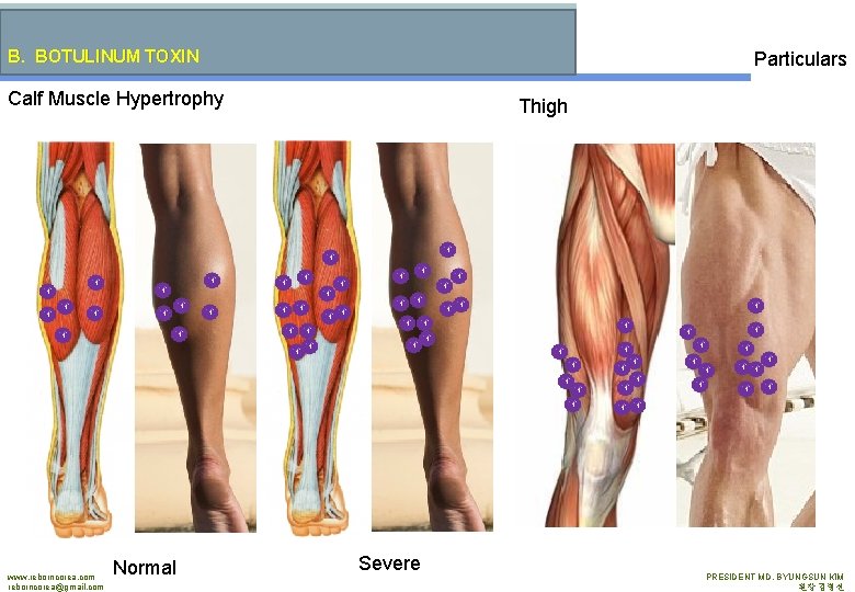 B. BOTULINUM TOXIN Particulars Calf Muscle Hypertrophy www. reborncorea. com reborncorea@gmail. com Normal Thigh