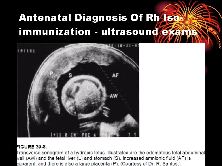 Antenatal Diagnosis Of Rh Isoimmunization - ultrasound exams 