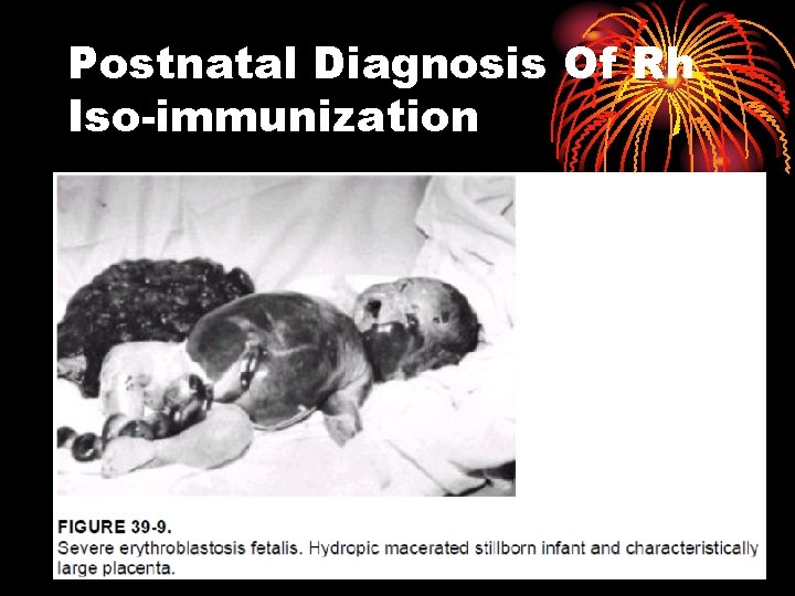 Postnatal Diagnosis Of Rh Iso-immunization 