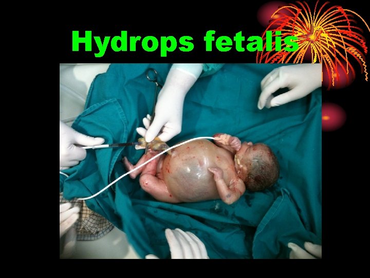 Hydrops fetalis 