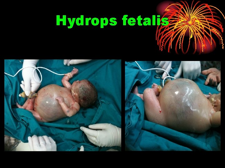 Hydrops fetalis 