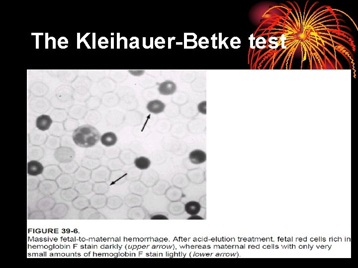 The Kleihauer-Betke test 