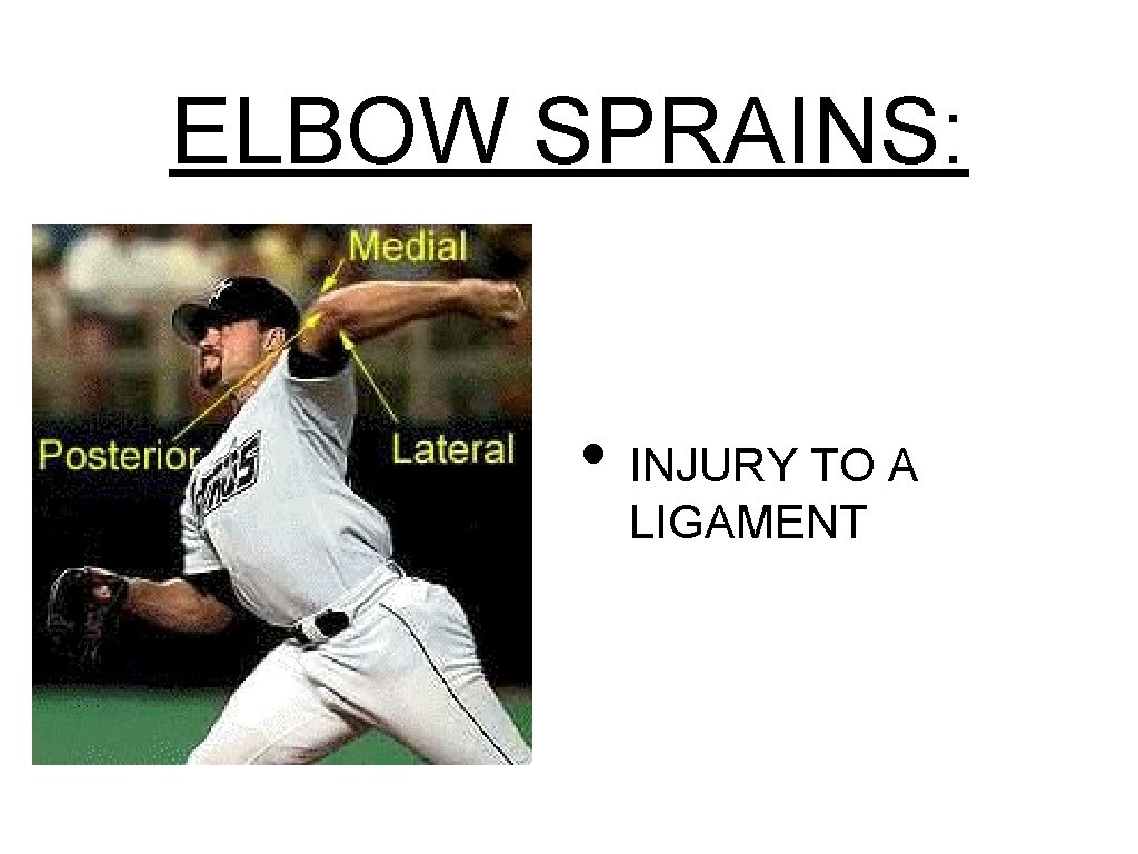 ELBOW SPRAINS: • INJURY TO A LIGAMENT 