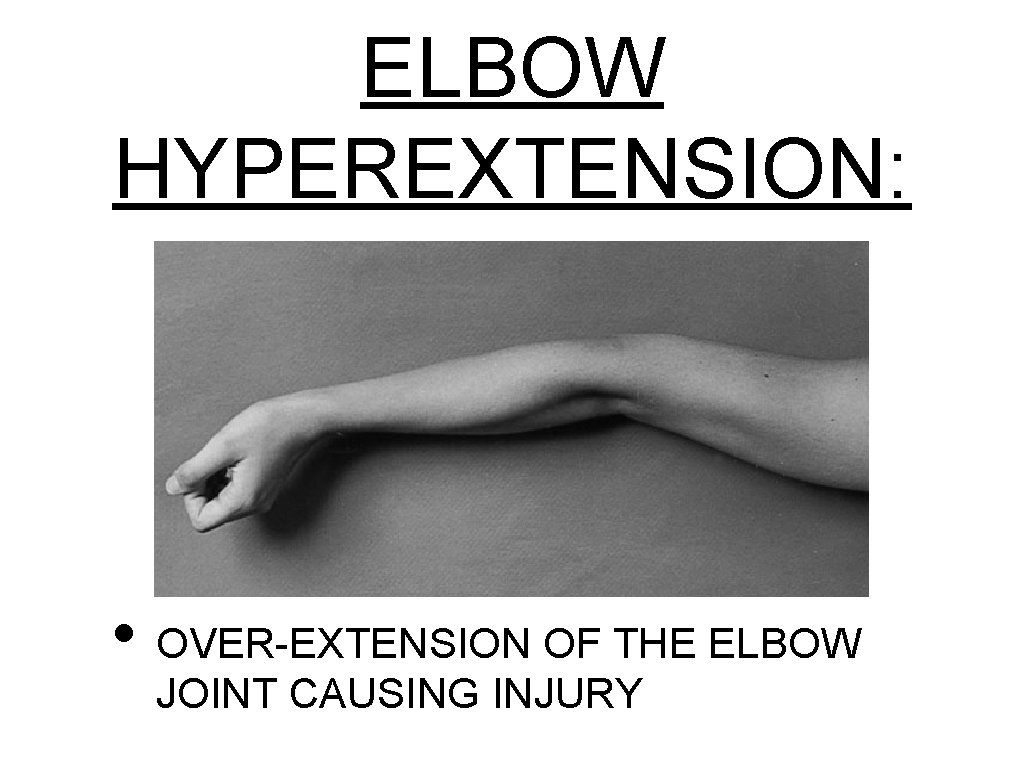 ELBOW HYPEREXTENSION: • OVER-EXTENSION OF THE ELBOW JOINT CAUSING INJURY 