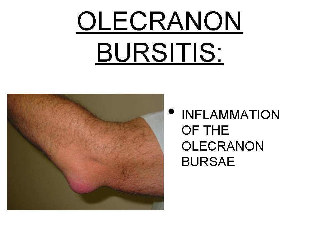 OLECRANON BURSITIS: • INFLAMMATION OF THE OLECRANON BURSAE 