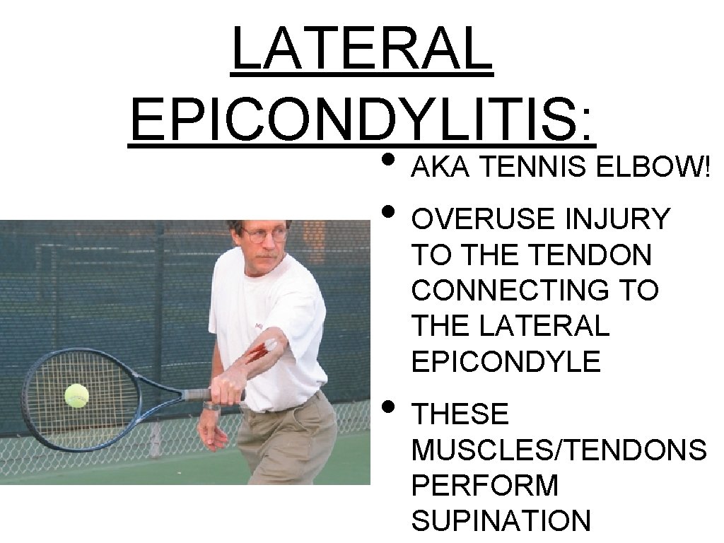 LATERAL EPICONDYLITIS: • AKA TENNIS ELBOW! • OVERUSE INJURY TO THE TENDON CONNECTING TO