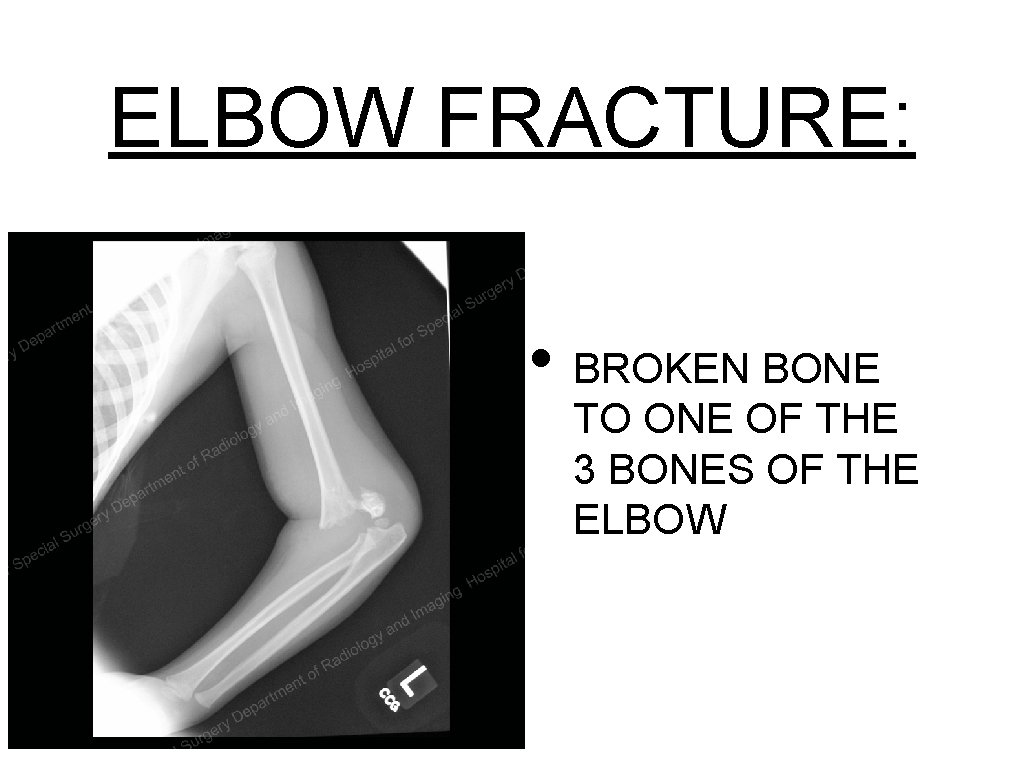 ELBOW FRACTURE: • BROKEN BONE TO ONE OF THE 3 BONES OF THE ELBOW