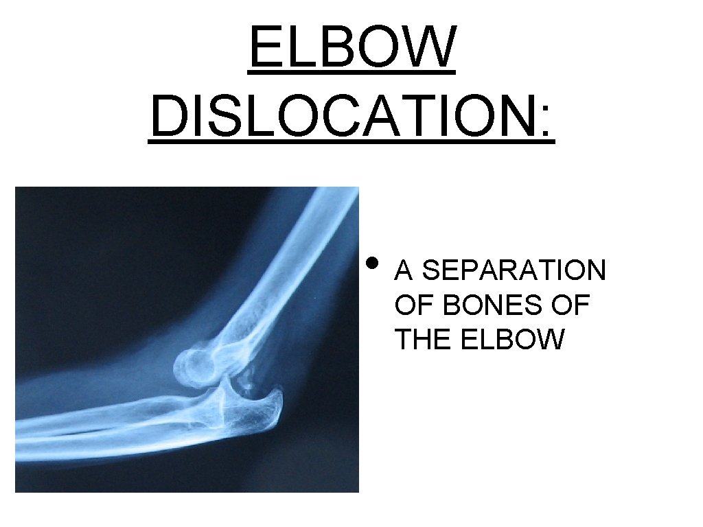 ELBOW DISLOCATION: • A SEPARATION OF BONES OF THE ELBOW 