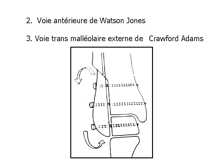 2. Voie antérieure de Watson Jones 3. Voie trans malléolaire externe de Crawford Adams