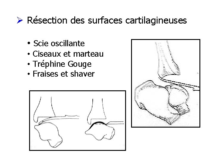 Ø Résection des surfaces cartilagineuses • Scie oscillante • Ciseaux et marteau • Tréphine