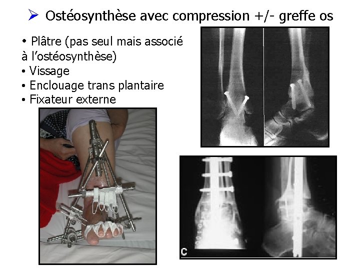Ø Ostéosynthèse avec compression +/- greffe os • Plâtre (pas seul mais associé à