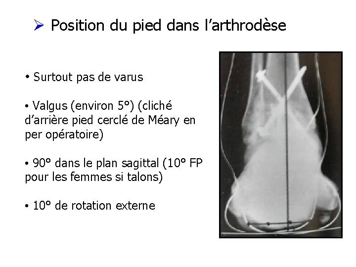 Ø Position du pied dans l’arthrodèse • Surtout pas de varus • Valgus (environ