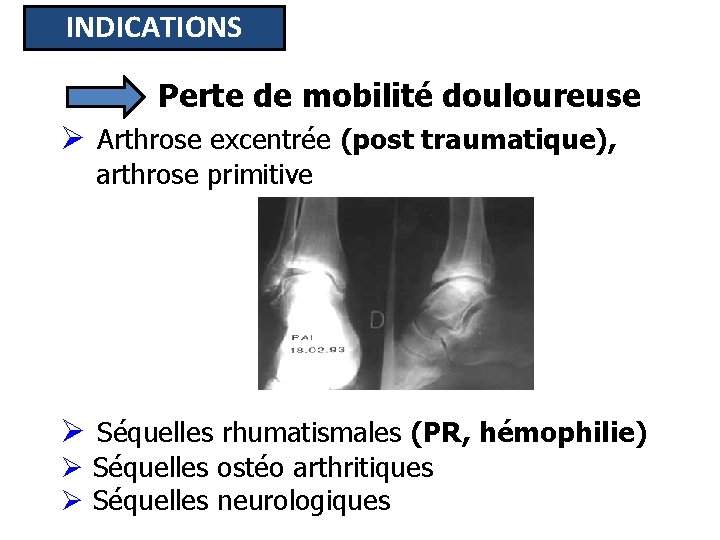 INDICATIONS Perte de mobilité douloureuse Ø Arthrose excentrée (post traumatique), arthrose primitive Ø Séquelles