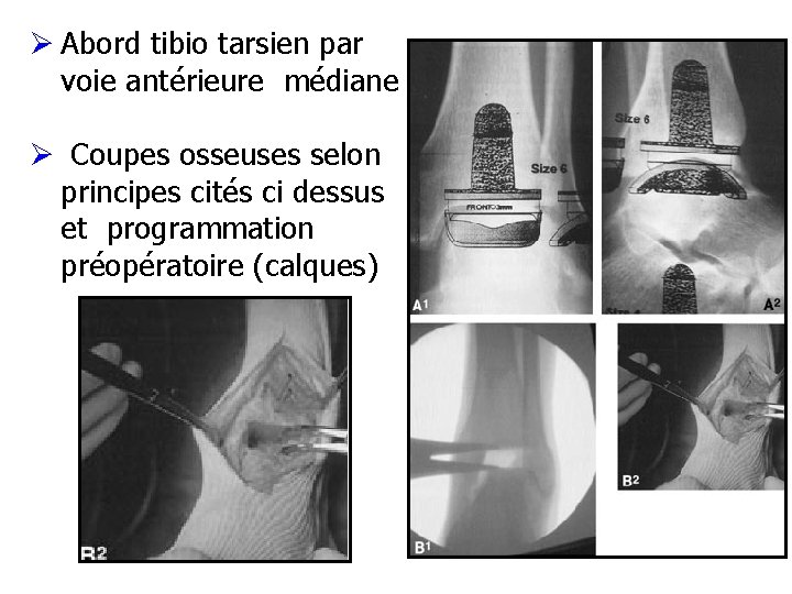 Ø Abord tibio tarsien par voie antérieure médiane Ø Coupes osseuses selon principes cités