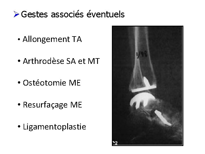 Ø Gestes associés éventuels • Allongement TA • Arthrodèse SA et MT • Ostéotomie