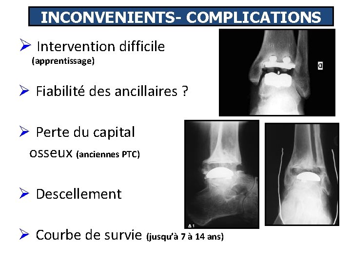 INCONVENIENTS- COMPLICATIONS Ø Intervention difficile (apprentissage) Ø Fiabilité des ancillaires ? Ø Perte du