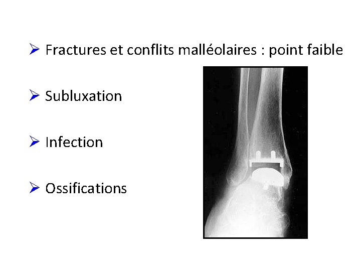 Ø Fractures et conflits malléolaires : point faible Ø Subluxation Ø Infection Ø Ossifications