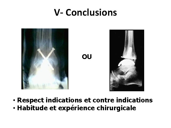 V- Conclusions OU • Respect indications et contre indications • Habitude et expérience chirurgicale
