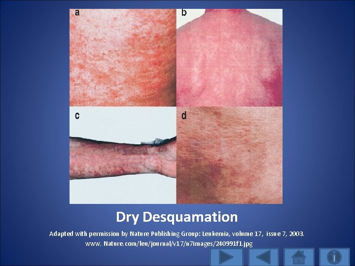Dry Desquamation Adapted with permission by Nature Publishing Group: Leukemia, volume 17, issue 7,