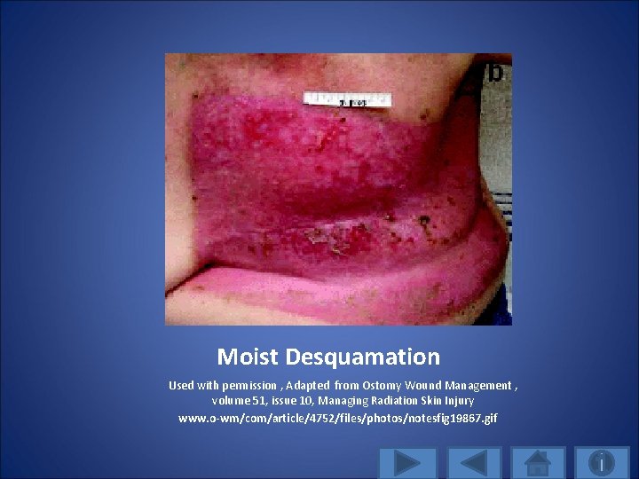Moist Desquamation Used with permission , Adapted from Ostomy Wound Management , volume 51,