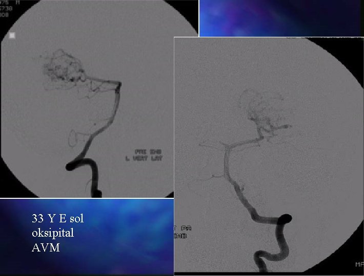 33 Y E sol oksipital AVM 