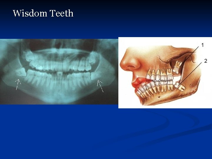 Wisdom Teeth 