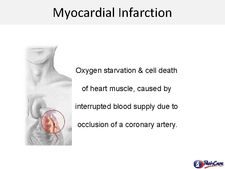 Myocardial Infarction Oxygen starvation & cell death of heart muscle, caused by interrupted blood